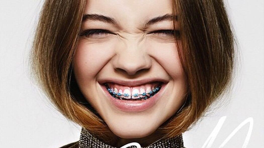 Are braces really a new fashion trend?