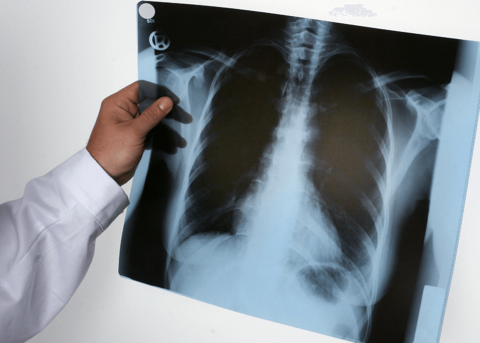 Tuberculosis identified at Brookline day care