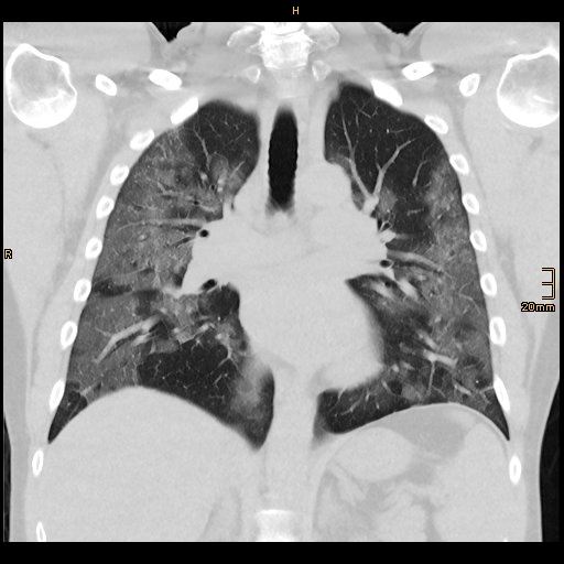 FILE PHOTO: The lungs of 48-year-old coronavirus disease (COVID-19) patient