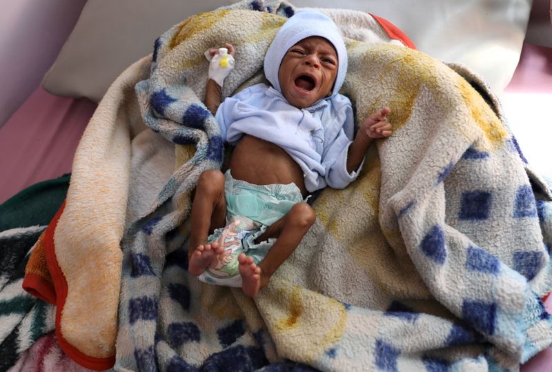 Child malnutrition at record highs in parts of Yemen -U.N.