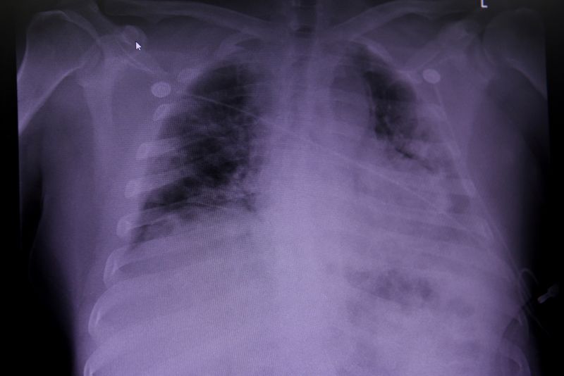 FILE PHOTO: An X-ray of a COVID-19 patient’s lungs at