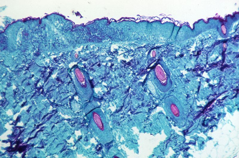 A section of skin tissue, harvested from a lesion on