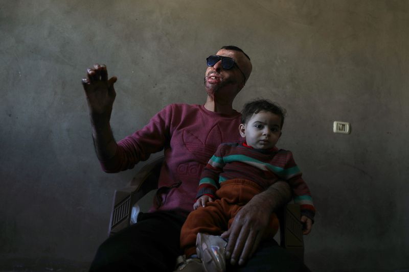 Gaza burn victims get 3D-printer face masks made close to