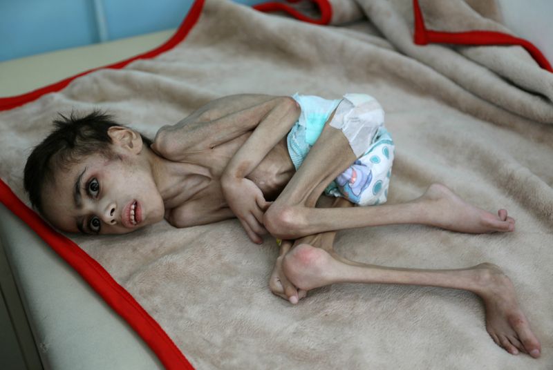 FILE PHOTO: Faid Samim, 7, a malnourished boy who also