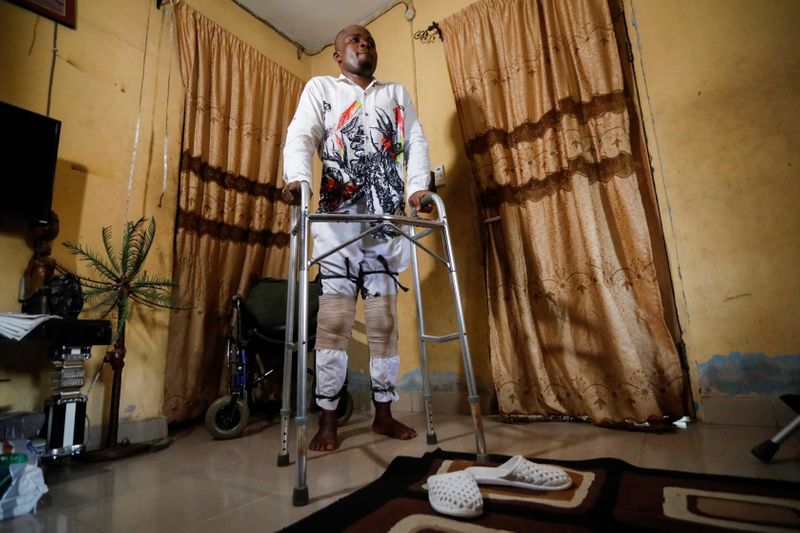 Ndukwe Ekekwe, a victim of the Nigerian police brutality, uses