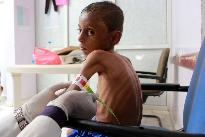 Doctor measure the arm of malnourished boy Hassan Merzam Muhammad,